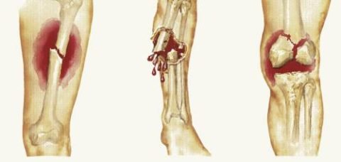 Антибіотики при переломах кісток: причини застосування та профілактика ускладнень