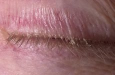 Алергічний дерматит на повіках очей: лікування та профілактика