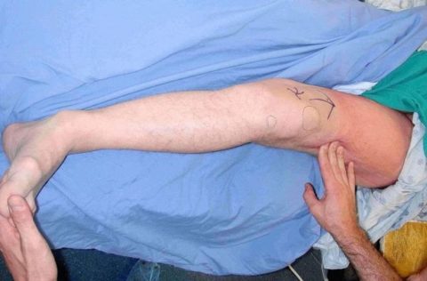 Перелом ноги у дитини – симптоми, діагностика, лікування