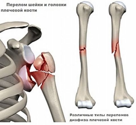 Складні переломи плеча: різновиди травм і можливі ускладнення