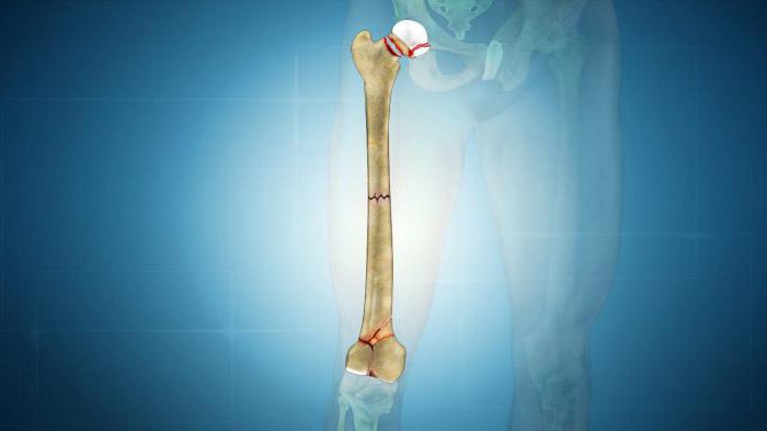 Патологічний перелом стегнової кістки: різновиди, причини, симптоматика та методи лікування