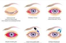 Очні краплі для судин очей: лікування лопнув судини