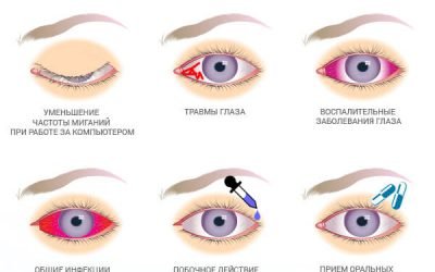 Очні краплі для судин очей: лікування лопнув судини