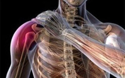 Перелом великого горбка плечової кістки зі зміщенням і без: лікування та реабілітація
