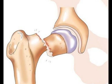 Операція при переломі шийки стегна: види та особливості хірургічних втручань, показання та обмеження