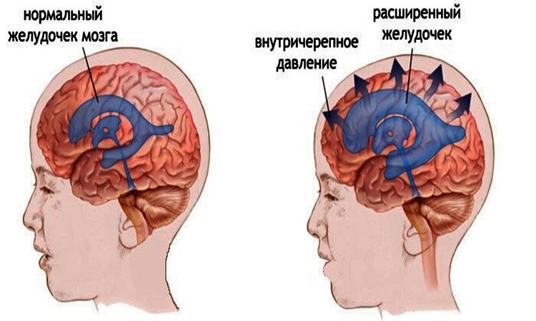 Внутричерепное давление головного мозга. Гипертензия головного мозга. Черепно мозговое давление. Внутричерепная гипертензия давление.