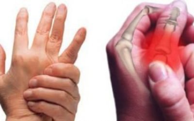 Закритий перелом пальця: причини, різновиди, симптоматичні характеристики, діагностика і способи лікування