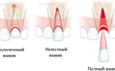 Вивих зуба: повний, неповний і вколочений, симптоми і лікування, реабілітація