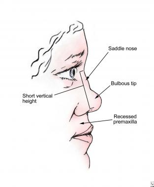 Операція при перелом носа зі зміщенням – як повернути колишню форму