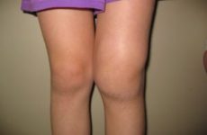 Набряк колінного суглоба: причини, лікування і артроскопія при болях