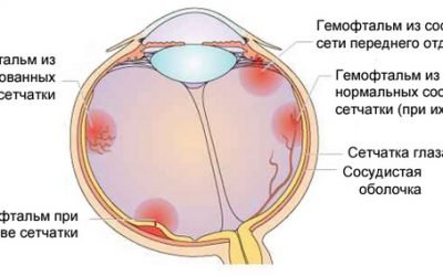 Лопаються судини (капіляри) в очах: причини, лікування і що робити