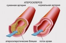 Атеросклероз легень: виявлення і лікування патології легеневих артерій
