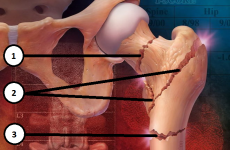 ЛФК при переломі шийки стегна або стегнової кістки: особливості етапів реабілітації та вправи, показані кожному потерпілому