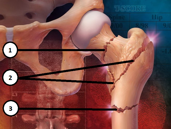 ЛФК при переломі шийки стегна або стегнової кістки: особливості етапів реабілітації та вправи, показані кожному потерпілому