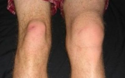 Вивих колінного суглоба: симптоми і лікування, перша допомога при травмі і реабілітація