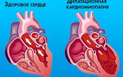 Що таке дисметаболічна кардіоміопатія