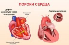Порок серця: що це таке, класифікація, причини, симптоми і лікування
