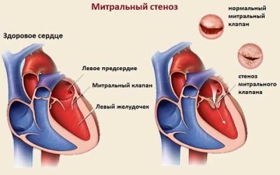 Ревматична хвороба серця: діагностика та лікування
