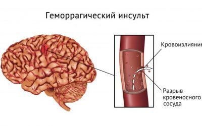 Інсульт мозку — види, симптоматика, діагностика і методи лікування