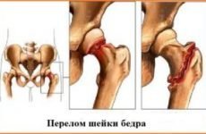 Знеболювання при переломі шийки стегна: види засобів і правила їх застосування