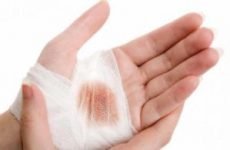 Чим підсушити рану: підсушуючі кошти і мазі, народні рецепти лікування мокнучих ран