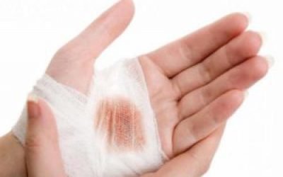 Чим підсушити рану: підсушуючі кошти і мазі, народні рецепти лікування мокнучих ран