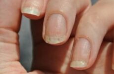 Екзема нігтів: причини, симптоми і лікування