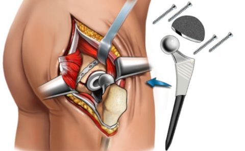 Протезування при переломі шийки стегна: особливості процедури, види операцій і терміни реабілітації