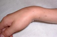 Вивих променево-зап’ясткового суглоба кисті руки: симптоми і лікування зап’ястя, перша допомога