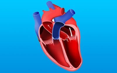 Ранні та пізні ускладнення після інфаркту міокарда: симптоми та корекція