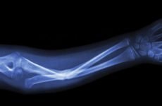 Лікування перелому променевої кістки: традиційна і народна медицина