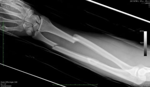 Як визначити перелом руки за зовнішніми ознаками і на рентгені