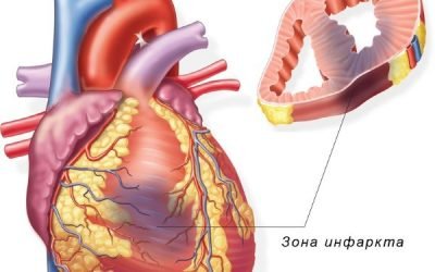Перенесений інфаркт “на ногах”: наслідки і симптоми у чоловіків і жінок