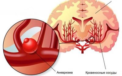 Розрив аневризми головного мозку: наслідки та лікування