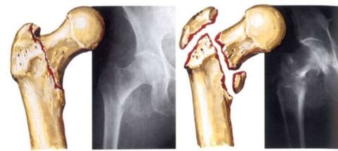 Операція при переломі шийки стегна: види та особливості хірургічних втручань, показання та обмеження