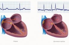 Як зняти напад аритмії серця в домашніх умовах