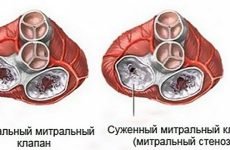 Мітральний стеноз: клінічні прояви і тактика терапії ревматичного пороку серця