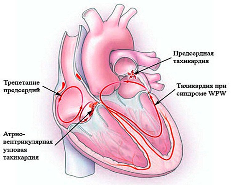 Предсердие болезни. Тахикардия. Наджелудочковый гребень. Тахикардия сердца. Частое сердцебиение.