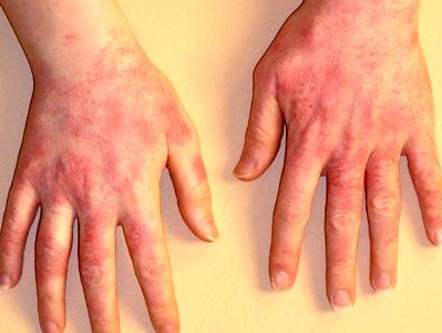 Чим відрізняється атопічний дерматит від алергії: різниця симптомів та лікування