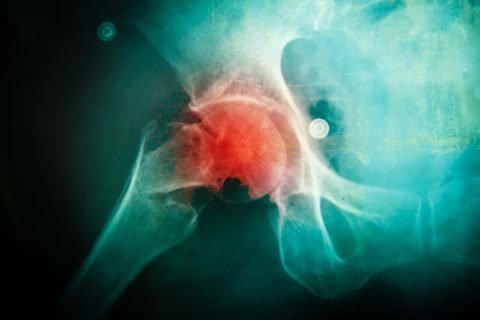 Закритий перелом стегна: види, симптоми, причини, методи діагностики та лікування