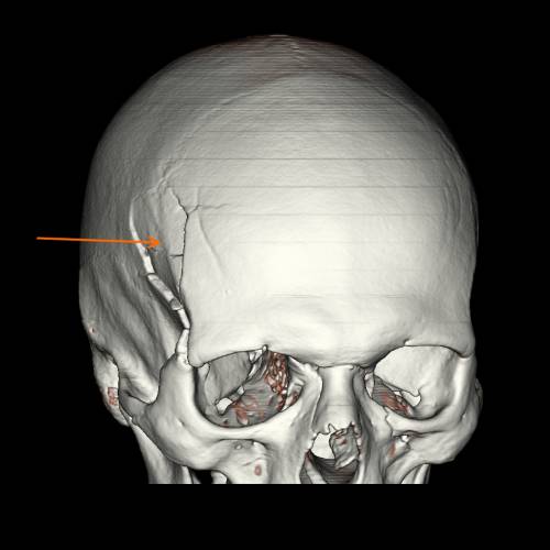Перелом основи черепа: причини, симптоми, прогноз