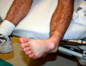 Підвивих гомілковостопного суглоба: симптоми і лікування травми стопи, перша допомога