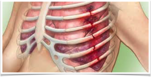 Симптоми перелому або тріщини ребра: характерні особливості та відмінності ушкоджень, їх діагностика і лікування
