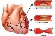 Що таке шунтування серця і судин після інфаркту: операція та реабілітація