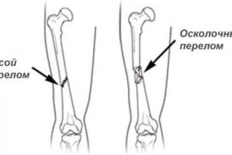 Осколковий перелом стегнової кістки: особливості травми, діагностика і лікування