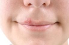 Герпес у роті, на губах у дорослих: лікування, ніж лікувати в домашніх умовах, симптоми