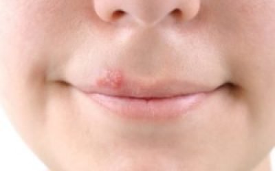 Герпес у роті, на губах у дорослих: лікування, ніж лікувати в домашніх умовах, симптоми
