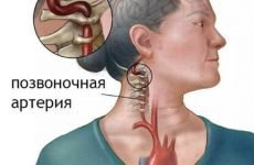 Страшенно болить голова при шийному остеохондрозі: чому, що робити і як лікувати?
