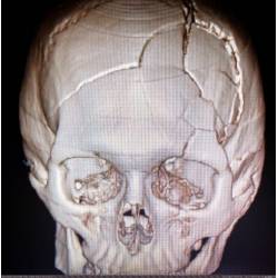 Перелом основи черепа: причини, симптоми, прогноз
