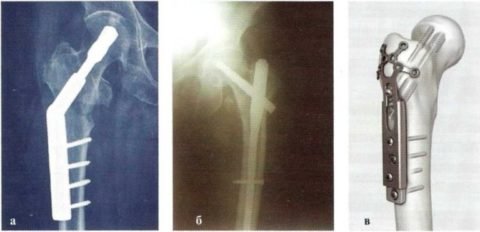 Осколковий перелом стегнової кістки: особливості травми, діагностика і лікування